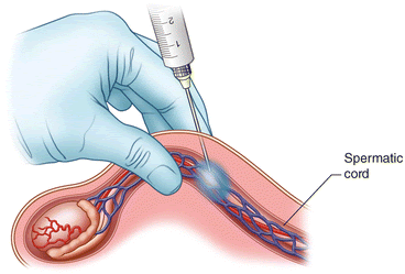 No-scalpel vasectomy